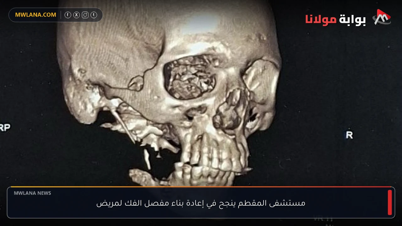 مستشفى المقطم ينجح في إعادة بناء مفصل الفك لمريض
