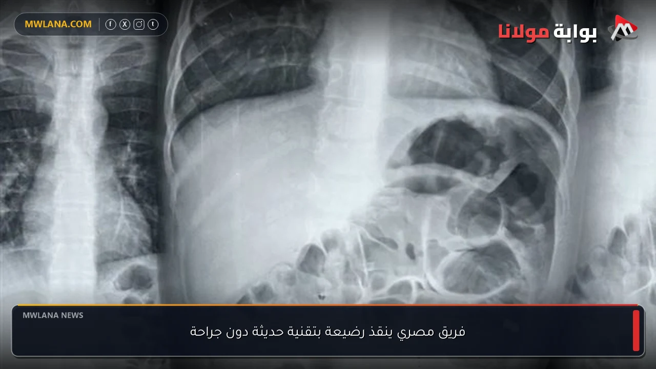 فريق مصري ينقذ رضيعة بتقنية حديثة دون جراحة