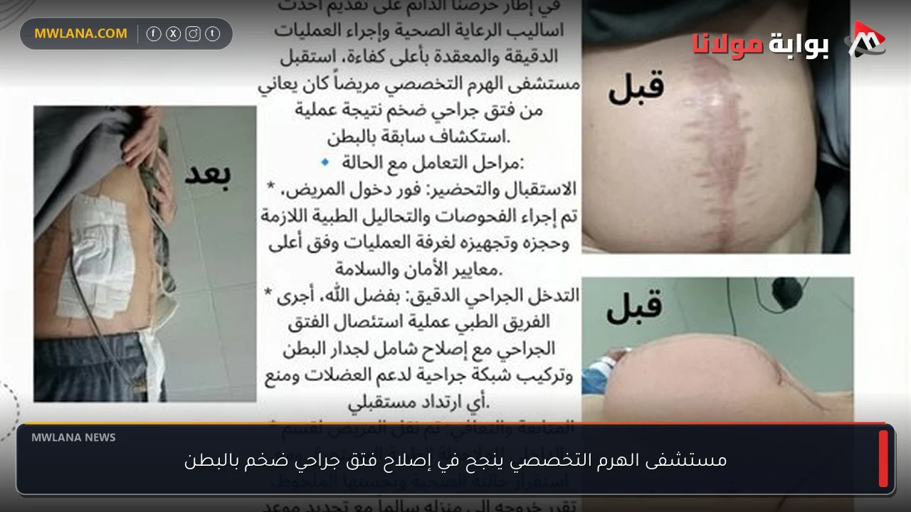 مستشفى الهرم التخصصي ينجح في إصلاح فتق جراحي ضخم بالبطن
