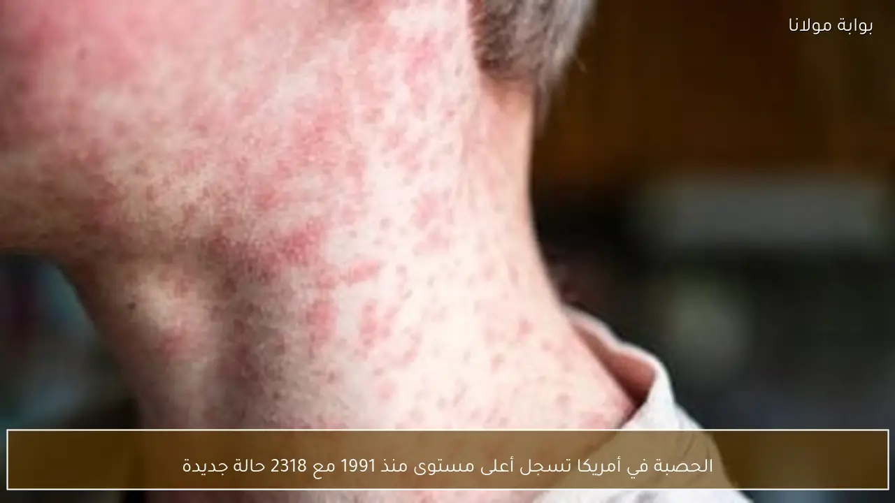 الحصبة في أمريكا تسجل أعلى مستوى منذ 1991 مع 2318 حالة جديدة