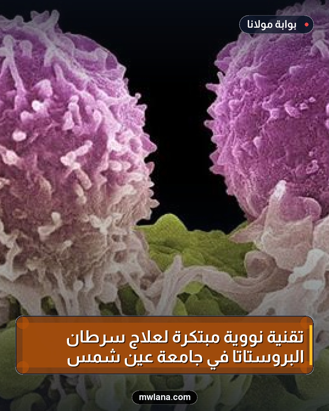تقنية نووية مبتكرة لعلاج سرطان البروستاتا في جامعة عين شمس