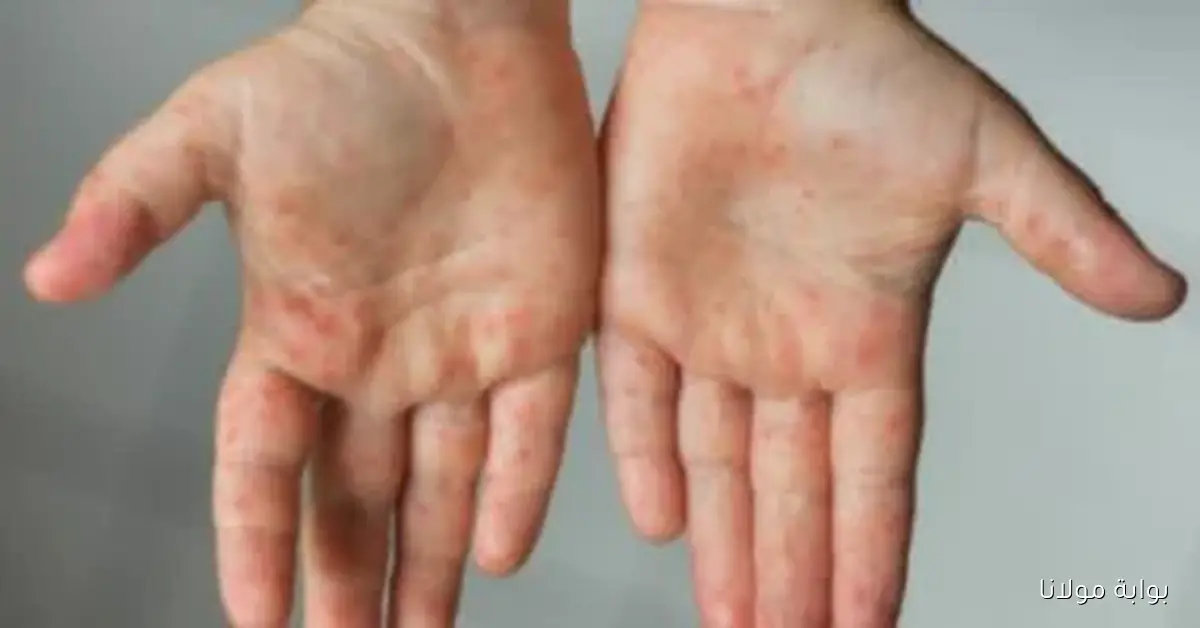 فيروس HFMD يظهر بين طلاب مدرسة في الجيزة ويدعو للقلق والتحرك السريع