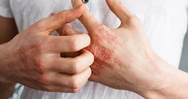 تغيرات بسيطة فى روتين الاستحمام تقلل من تفاقم إكزيما الشتاء