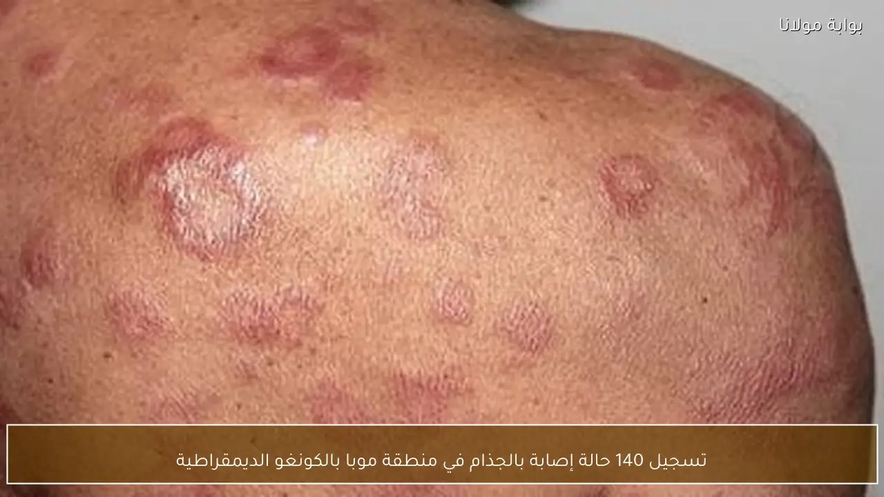 تسجيل 140 حالة إصابة بالجذام في منطقة موبا بالكونغو الديمقراطية