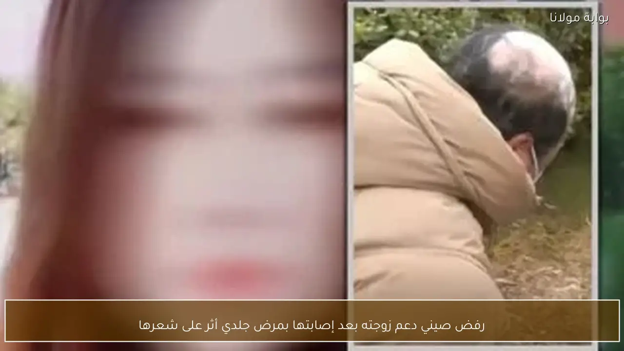 رفض صيني دعم زوجته بعد إصابتها بمرض جلدي أثر على شعرها