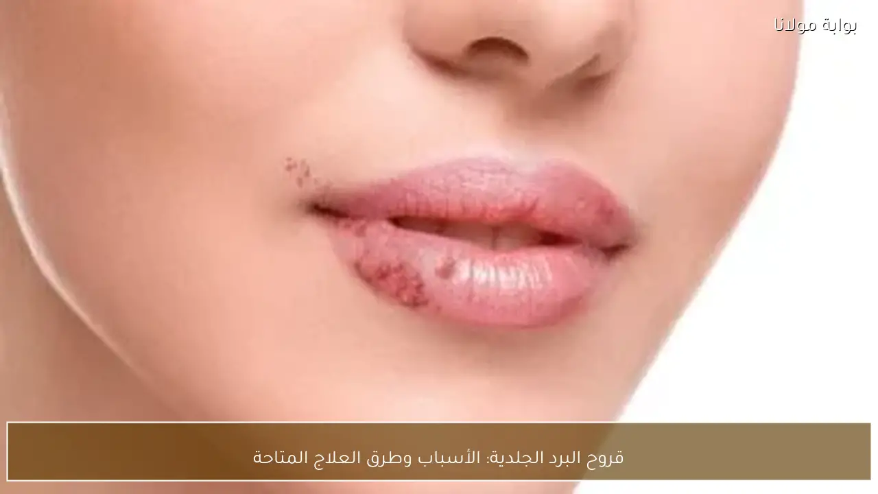 قروح البرد الجلدية: الأسباب وطرق العلاج المتاحة
