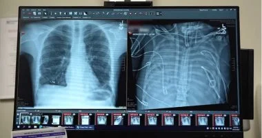 بإستخدام رئة اصطناعية.. أطباء ينجحون فى إنقاذ حياة مريض بعد استئصال رئتيه