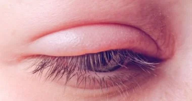 أسباب تورم العين بسبب الحساسية.. اعرف طرق العلاج الفعاله أسباب تورم العين بسبب الحساسية.. اعرف طرق العلاج الفعاله