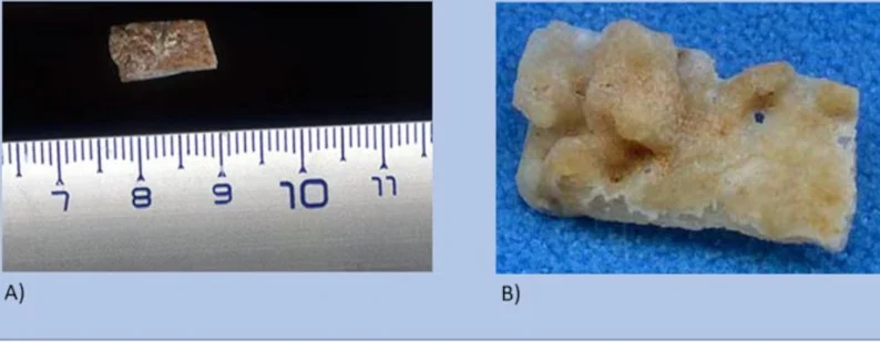 قطع آخرى من الجمجمة قطع آخرى من الجمجمة