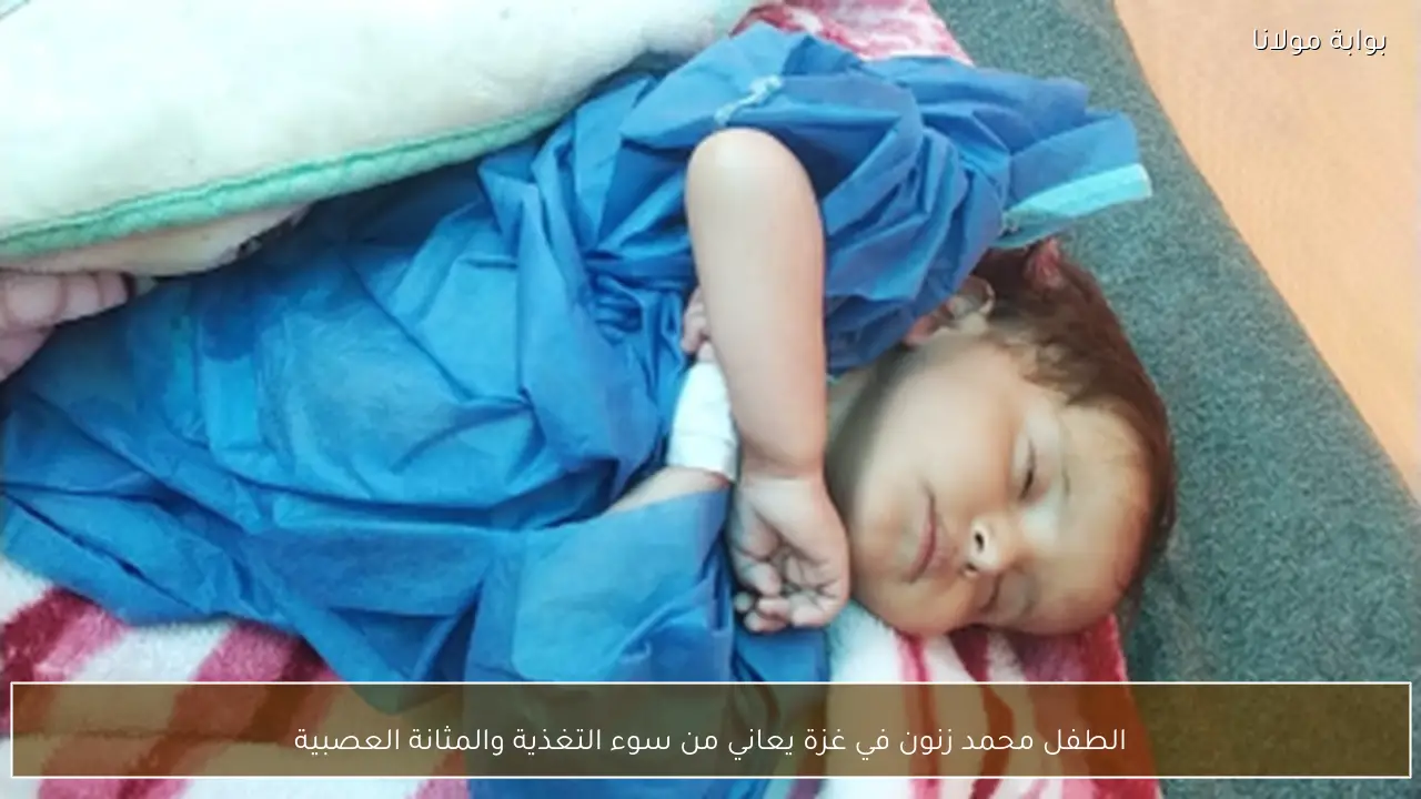الطفل محمد زنون في غزة يعاني من سوء التغذية والمثانة العصبية