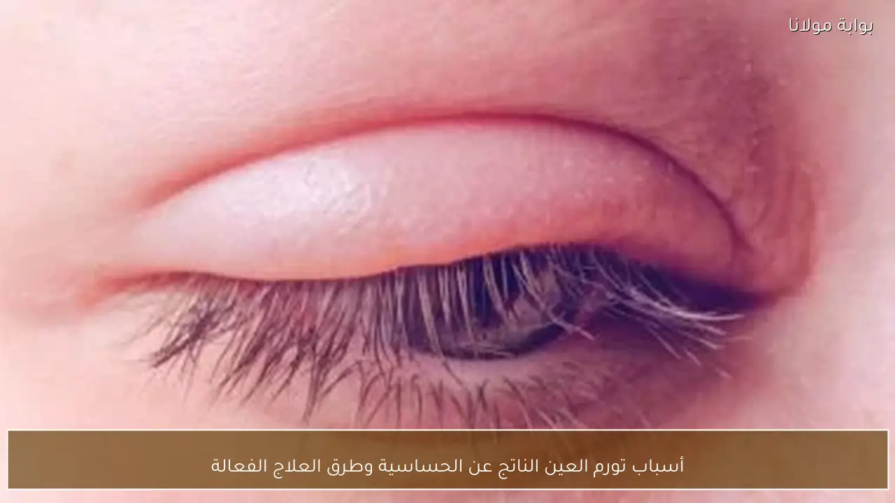 أسباب تورم العين الناتج عن الحساسية وطرق العلاج الفعالة