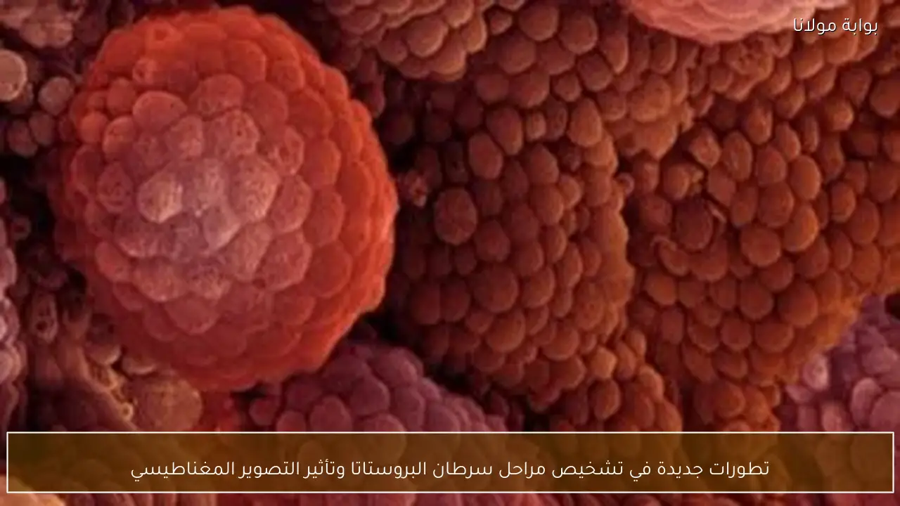 تطورات جديدة في تشخيص مراحل سرطان البروستاتا وتأثير التصوير المغناطيسي