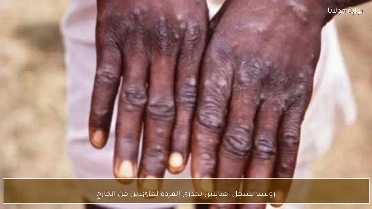 روسيا تسجل إصابتين بجدرى القردة لعائدين من الخارج