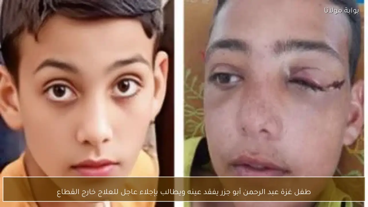 طفل غزة عبد الرحمن أبو جزر يفقد عينه ويطالب بإجلاء عاجل للعلاج خارج القطاع