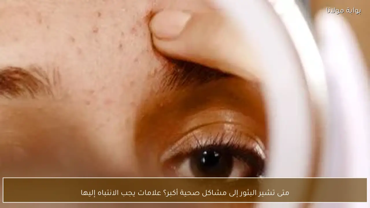 متى تشير البثور إلى مشاكل صحية أكبر؟ علامات يجب الانتباه إليها