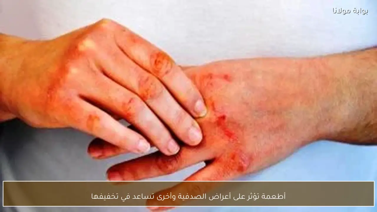 أطعمة تؤثر على أعراض الصدفية وأخرى تساعد في تخفيفها