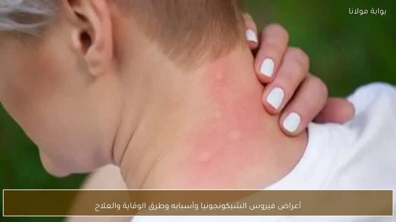 أعراض فيروس الشيكونجونيا وأسبابه وطرق الوقاية والعلاج