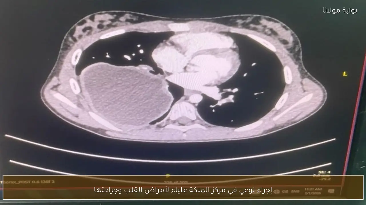 إجراء نوعي في مركز الملكة علياء لأمراض القلب وجراحتها