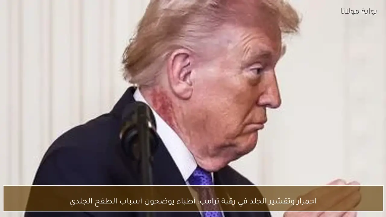 احمرار وتقشير الجلد في رقبة ترامب: أطباء يوضحون أسباب الطفح الجلدي
