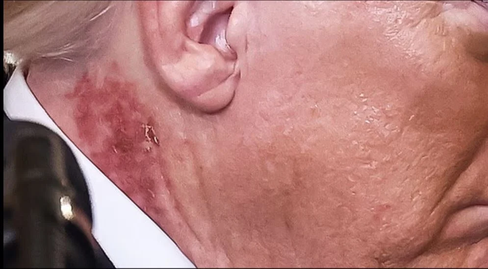 بقعة حمراء متقشرة برقبة ترامب