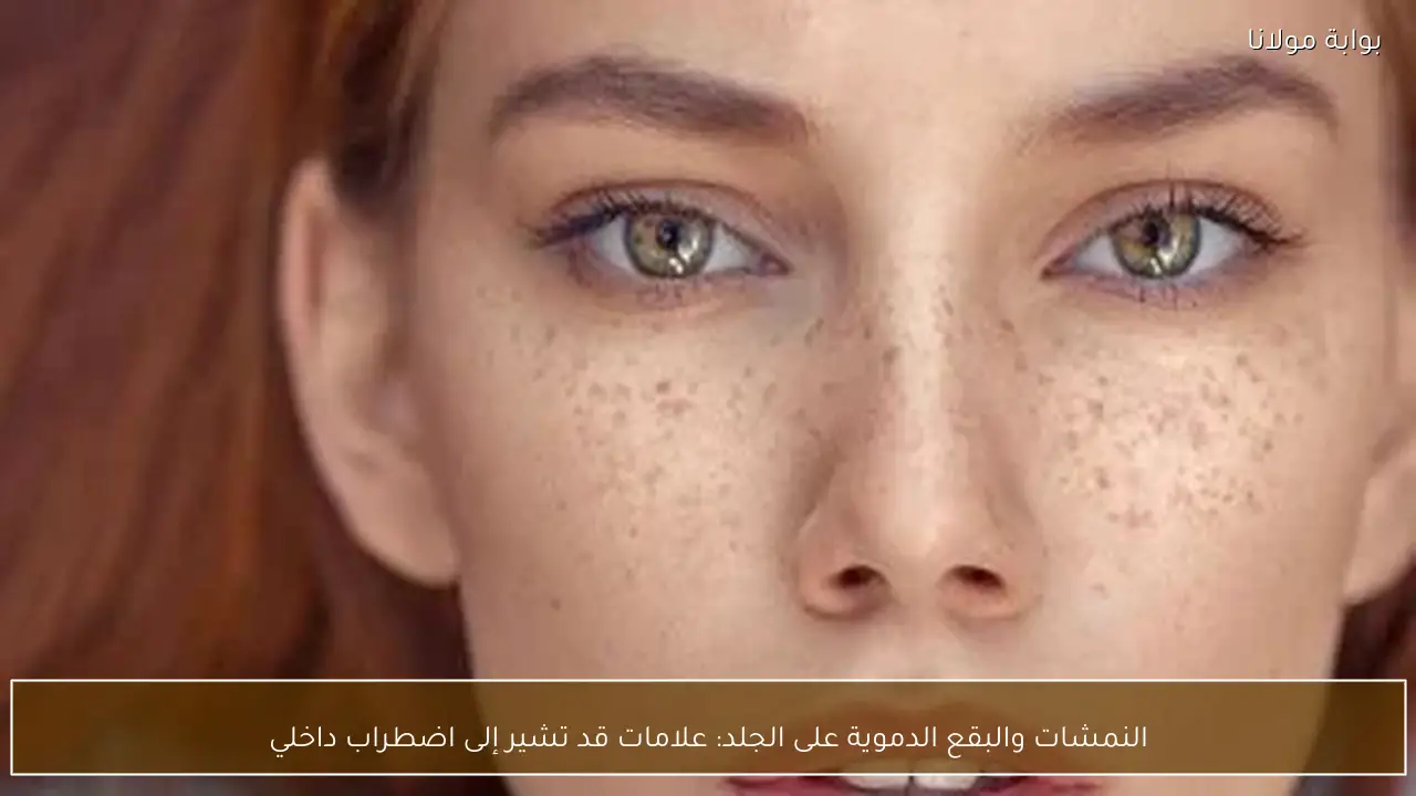 النمشات والبقع الدموية على الجلد: علامات قد تشير إلى اضطراب داخلي