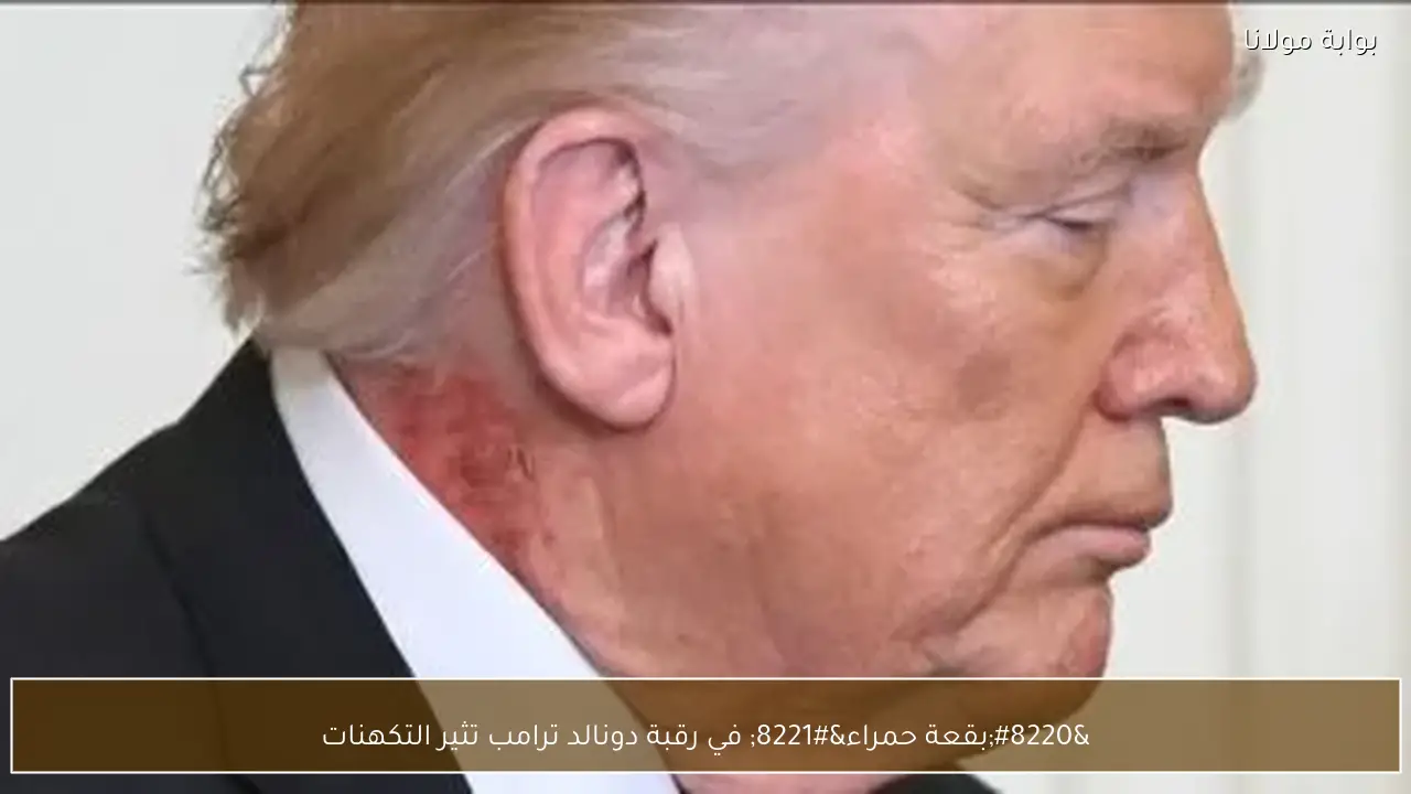 “بقعة حمراء” في رقبة دونالد ترامب تثير التكهنات