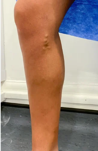 دوالى الساقين دوالى الساقين