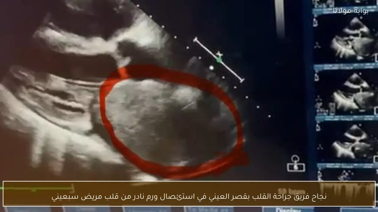 نجاح فريق جراحة القلب بقصر العيني في استئصال ورم نادر من قلب مريض سبعيني